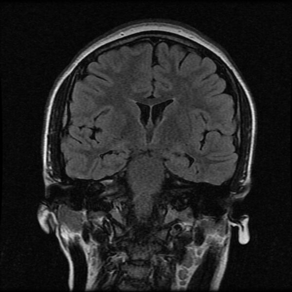 File:Cerebral cavernous malformation (Radiopaedia 44301-47942 Coronal FLAIR 10).jpg