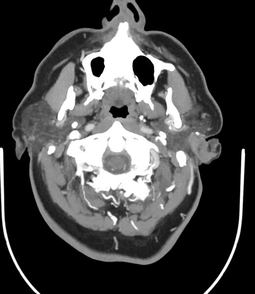 File:Cerebral dural venous sinus thrombosis (Radiopaedia 86514-102576 A 20).jpg