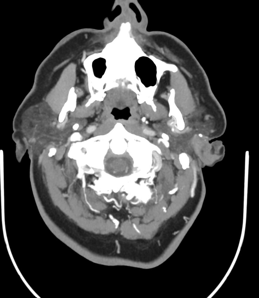 Cerebral dural venous sinus thrombosis (Radiopaedia 86514-102576 A 20).jpg