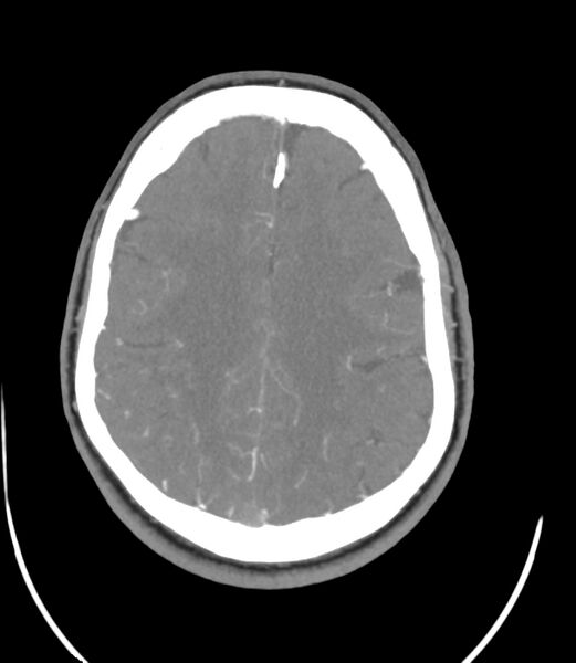 File:Cerebral dural venous sinus thrombosis (Radiopaedia 86514-102576 A 71).jpg