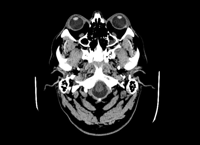 File:Cerebral edema (Radiopaedia 82519-96661 Axial non-contrast 50).jpg