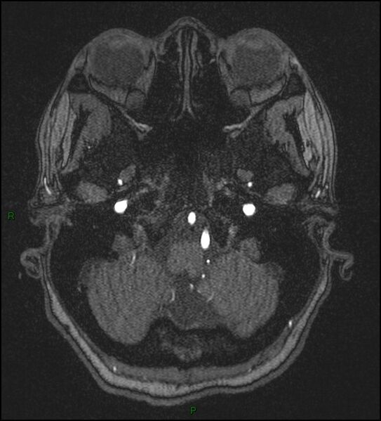 File:Cerebral fat embolism (Radiopaedia 35022-36525 Axial TOF 28).jpg