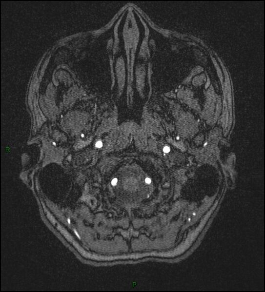 File:Cerebral fat embolism (Radiopaedia 35022-36525 Axial TOF 3).jpg