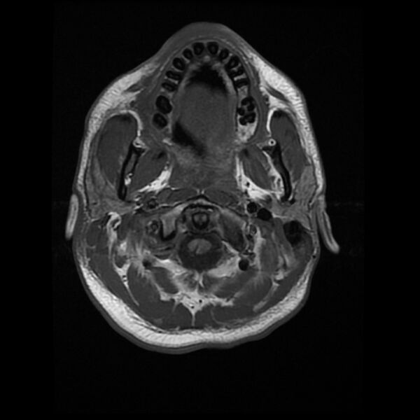 File:Cerebral fat embolism (Radiopaedia 37510-39363 Axial T1 2).jpg