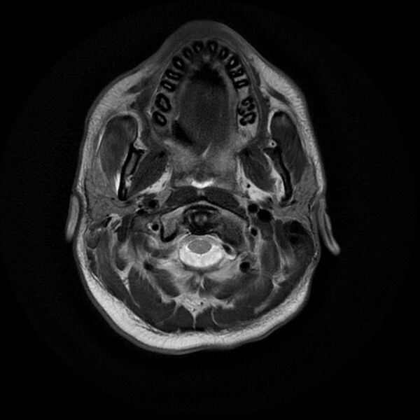 File:Cerebral fat embolism (Radiopaedia 37510-39363 Axial T2 2).jpg