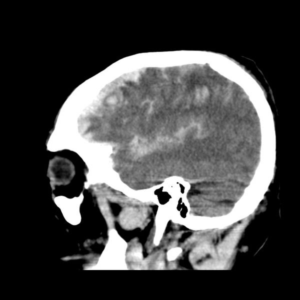 File:Cerebral hemorrhagic contusions (Radiopaedia 23145-23188 C 34).jpg