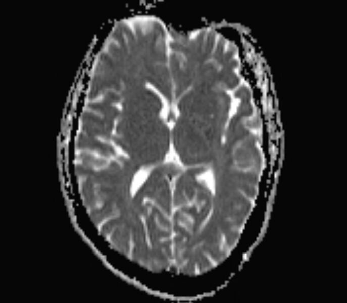 File:Cerebral venous thrombosis (Radiopaedia 71207-81504 Axial ADC 10).jpg