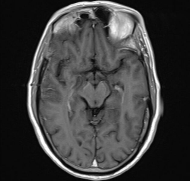 File:Cerebral venous thrombosis (Radiopaedia 71207-81504 Axial T1 C+ 11).jpg