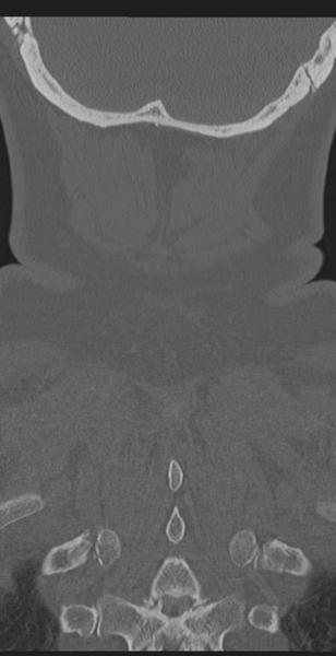 File:Cervical canal stenosis - OPLL and osteophytes (Radiopaedia 47329-51910 Coronal bone window 62).png