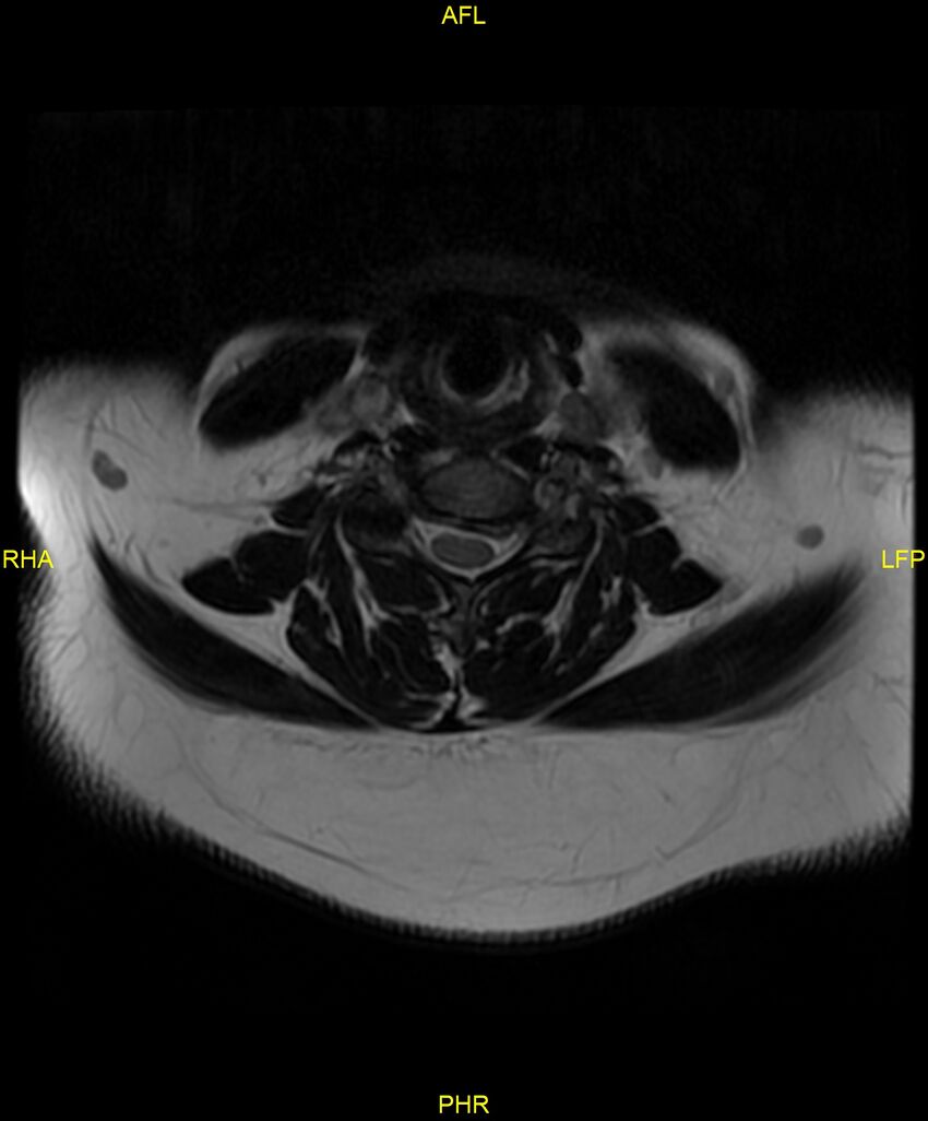 Cervical disc protrusion (Radiopaedia 87147-103415 Axial T2 32).jpg