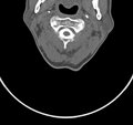 Cervical dural CSF leak on MRI and CT treated by blood patch (Radiopaedia 49748-54996 B 19).png