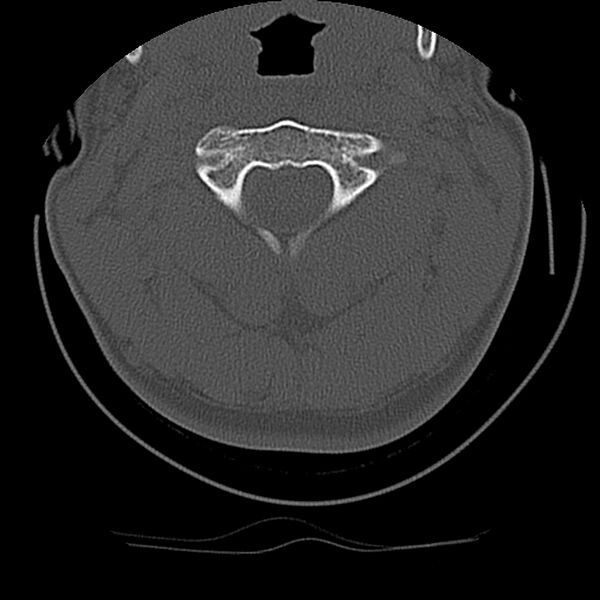 File:Cervical flexion teardrop fracture with cord hemorrhage (Radiopaedia 32497-33454 Axial bone window 24).jpg