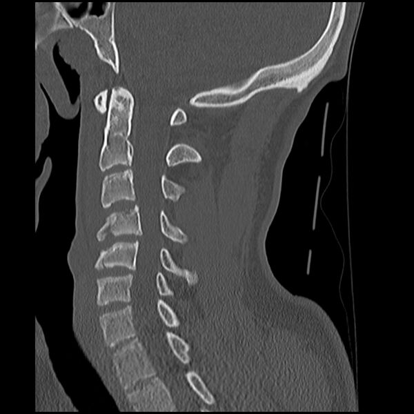 File:Cervical flexion teardrop fracture with cord hemorrhage (Radiopaedia 32497-33454 Sagittal bone window 21).jpg