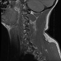 Cervical flexion teardrop fracture with cord hemorrhage (Radiopaedia 32497-33455 Sagittal T1 16).jpg