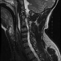 Cervical flexion teardrop fracture with cord hemorrhage (Radiopaedia 32497-33455 Sagittal T2 6).jpg