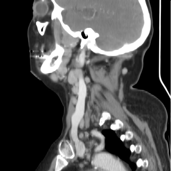 File:Cervical lymphadenopathy- cause unknown (Radiopaedia 22420-22457 D 29).jpg