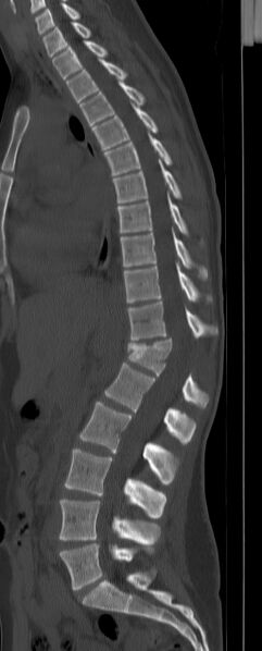 File:Chance fracture (Radiopaedia 45345-49372 Sagittal bone window 12).jpg