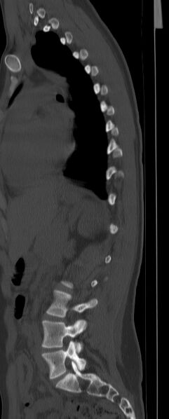 File:Chance fracture (Radiopaedia 45345-49372 Sagittal bone window 19).jpg