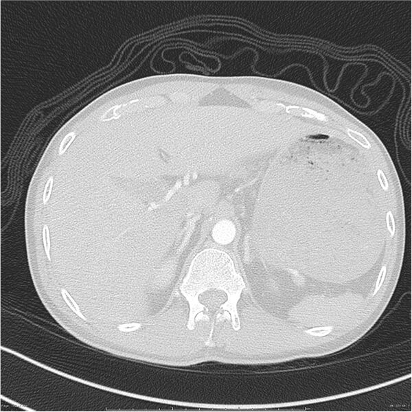 File:Chest and abdomen multi-trauma (Radiopaedia 26294-26425 lung window 102).jpg