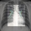 Chest x-ray - circulation (Radiopaedia 32664-33633 E 1).jpg
