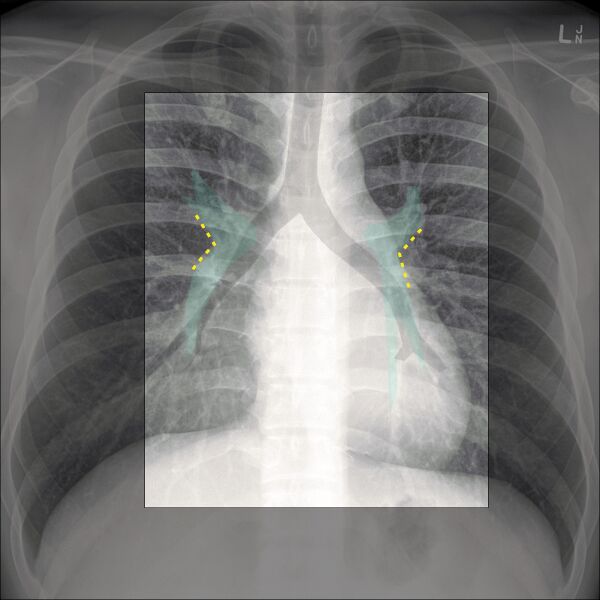 File:Chest x-ray - circulation (Radiopaedia 32664-33633 E 1).jpg