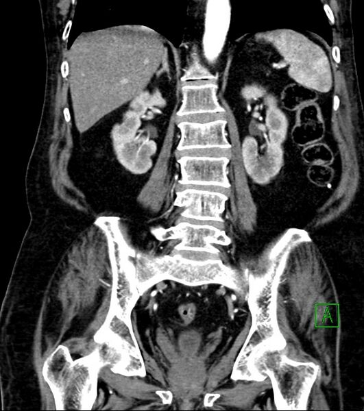 File:Cholangiocarcinoma with cerebral metastases (Radiopaedia 83519-98629 E 58).jpg