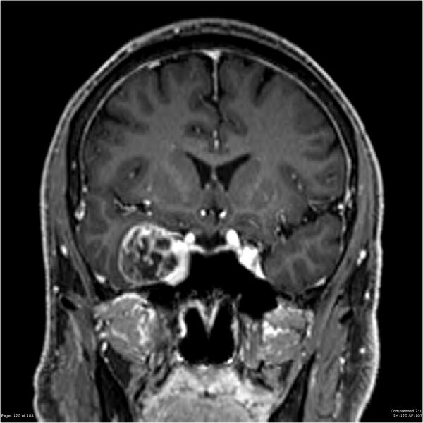 File:Chondrosarcoma of skull base- grade II (Radiopaedia 40948-43654 Coronal T1 C+ 31).jpg