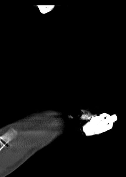 File:Chopart fracture (Radiopaedia 35347-36861 Sagittal bone window 21).jpg