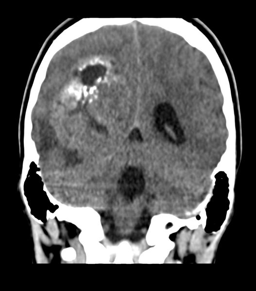 File:Choroid plexus carcinoma (Radiopaedia 91013-108552 Coronal non-contrast 59).jpg