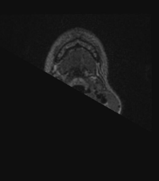 File:Choroid plexus carcinoma (Radiopaedia 91013-108553 Axial FLAIR C+ 15).jpg