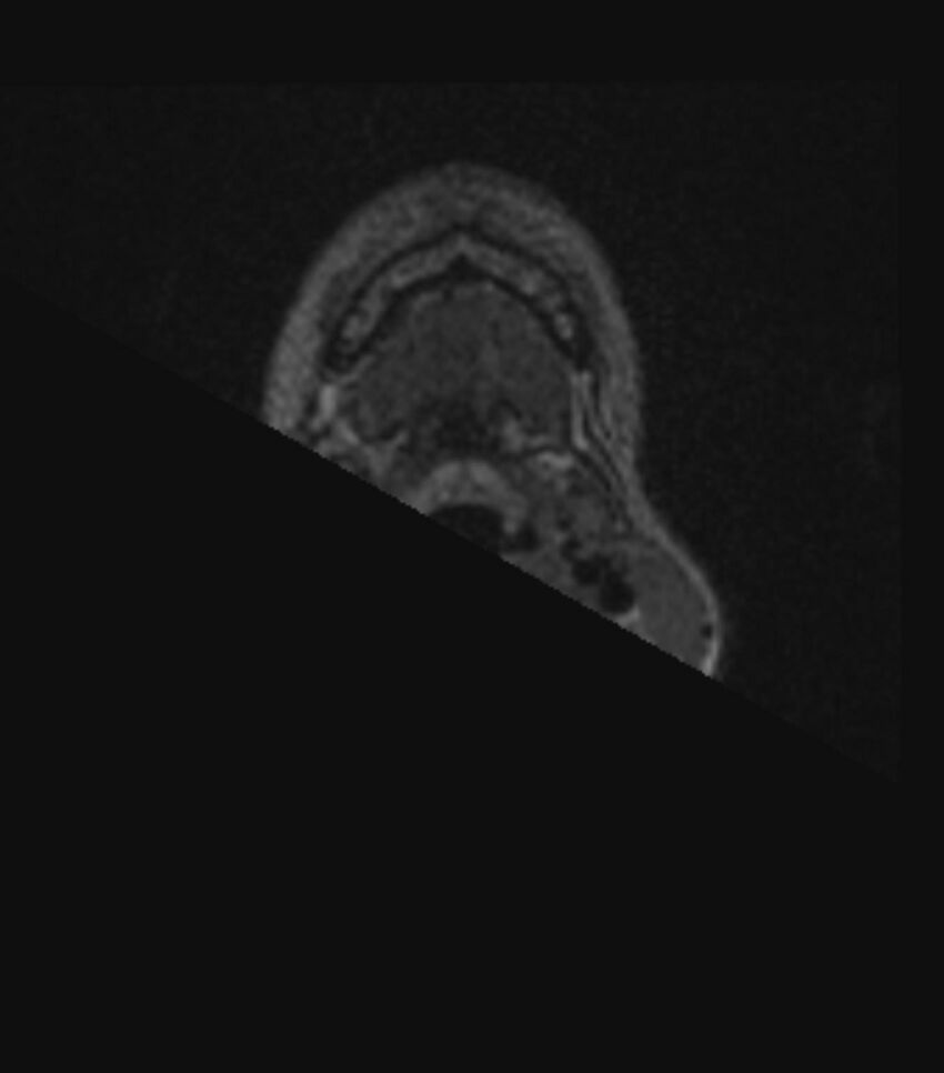 Choroid plexus carcinoma (Radiopaedia 91013-108553 Axial FLAIR C+ 15).jpg