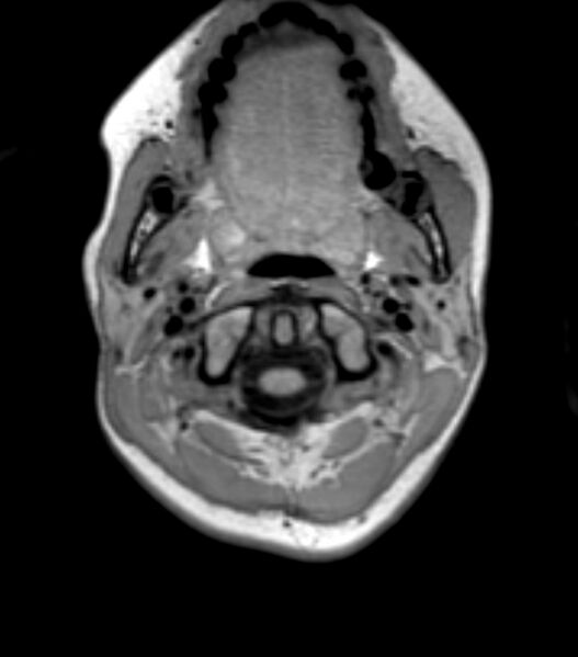 File:Choroid plexus carcinoma (Radiopaedia 91013-108553 Axial T1 14).jpg