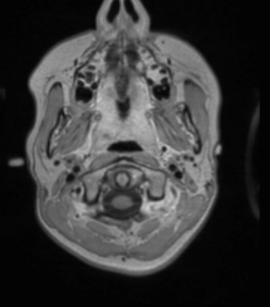 File:Choroid plexus carcinoma (Radiopaedia 91013-108553 Axial T1 C+ 61).jpg
