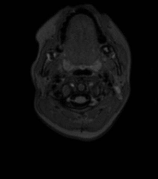 File:Choroid plexus carcinoma (Radiopaedia 91013-108553 Axial T2 fat sat 8).jpg