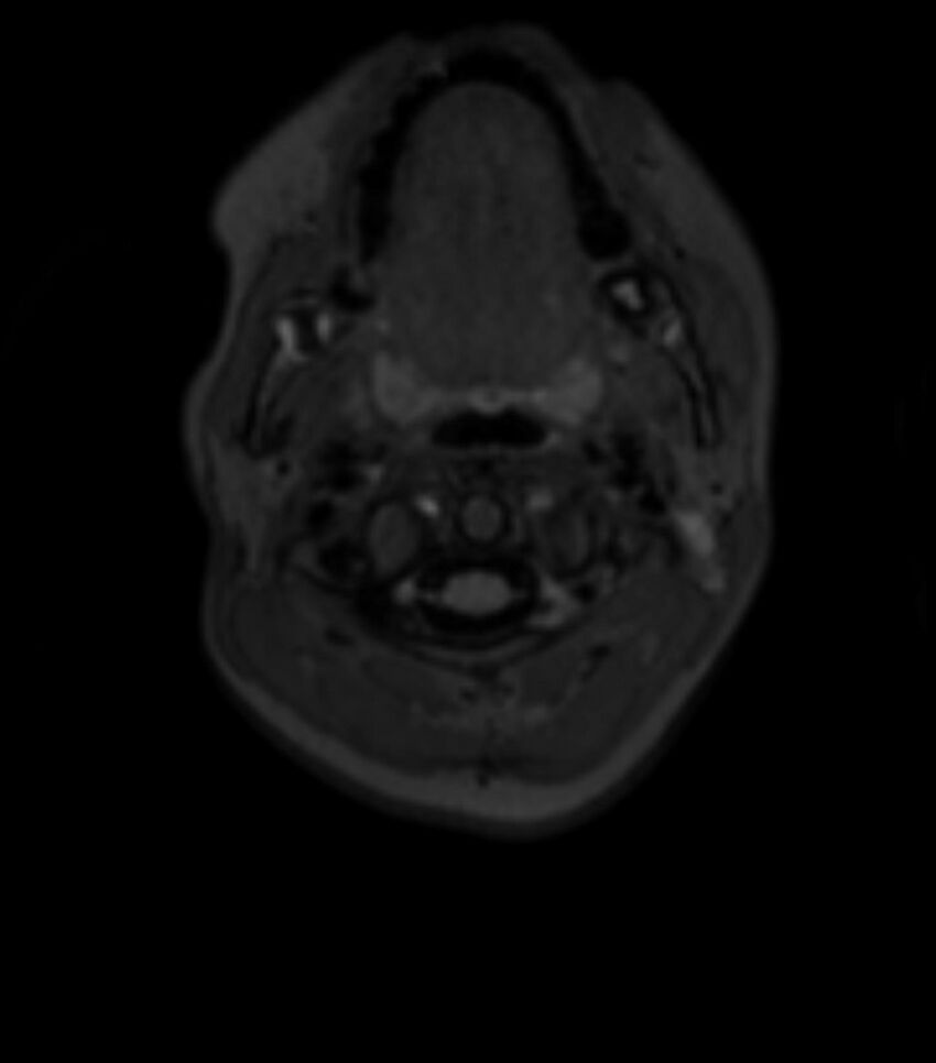 Choroid plexus carcinoma (Radiopaedia 91013-108553 Axial T2 fat sat 8).jpg