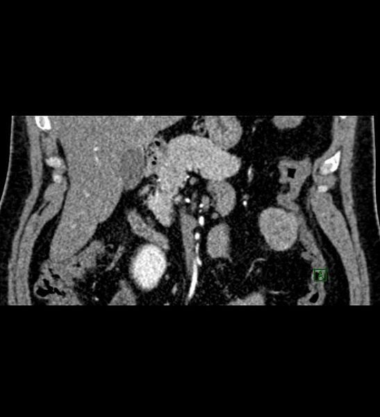File:Chromophobe renal cell carcinoma (Radiopaedia 84286-99573 E 12).jpg