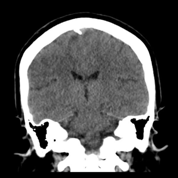 File:Chronic bilateral occipital lobe infarcts (Radiopaedia 31276-31996 Coronal non-contrast 29).jpg
