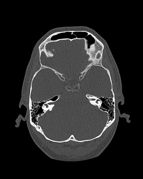 File:Chronic maxillary sinusitis caused by a foreign body (Radiopaedia 58521-65676 Axial bone window 262).jpg