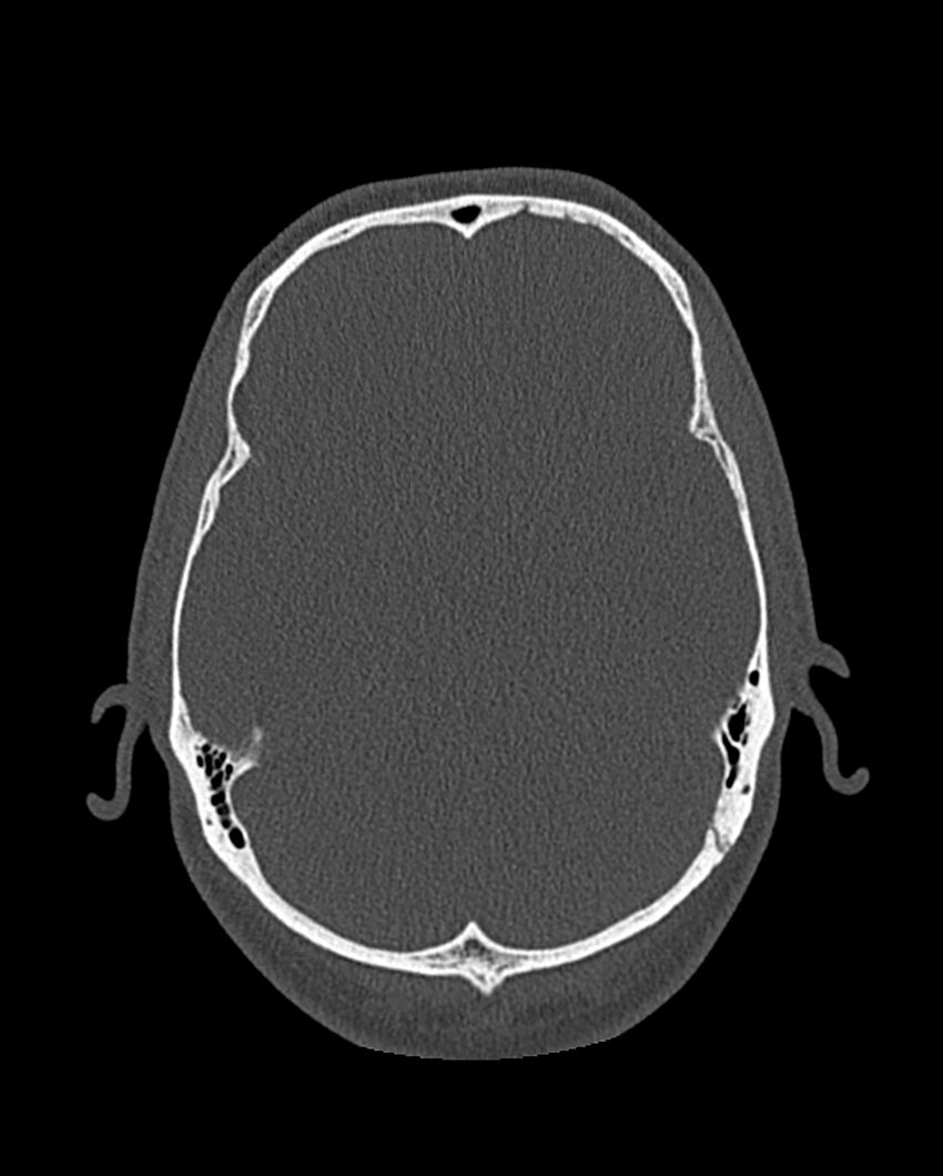 Chronic maxillary sinusitis caused by a foreign body (Radiopaedia 58521-65676 Axial bone window 308).jpg