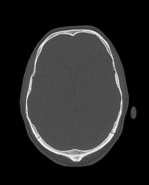 File:Chronic maxillary sinusitis caused by a foreign body (Radiopaedia 58521-65676 Axial bone window 346).jpg