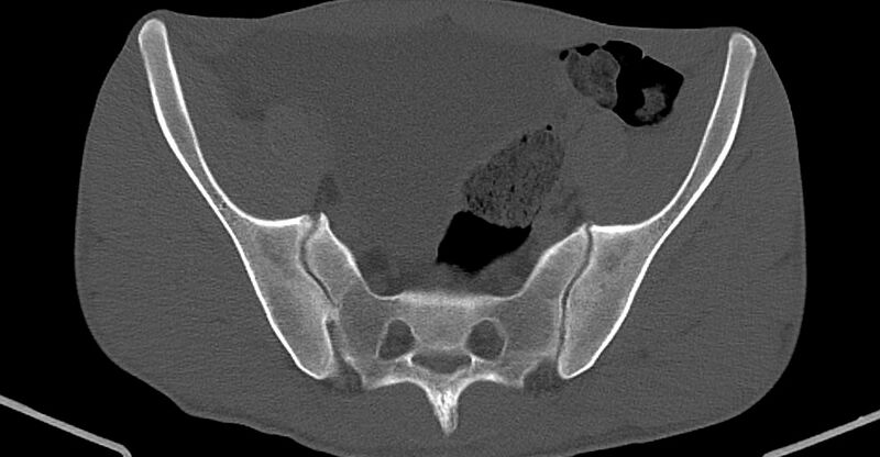 File:Chronic osteomyelitis (with sequestrum) (Radiopaedia 74813-85822 Axial 189).jpg