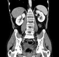 Chronic pancreatitis (Radiopaedia 23132-23172 C 40).jpg