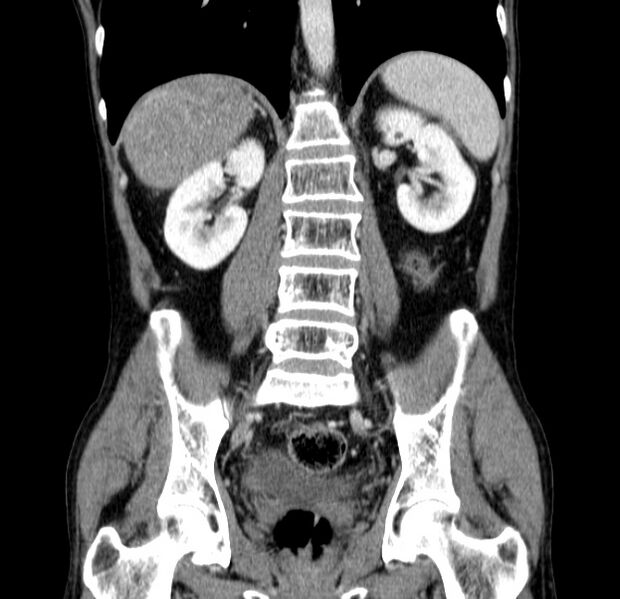 File:Chronic pancreatitis (Radiopaedia 23132-23172 C 40).jpg