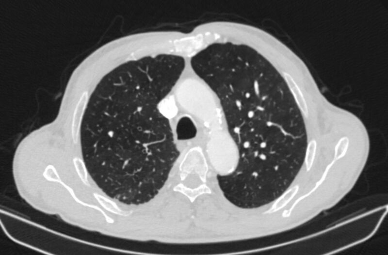 File:Chronic pulmonary embolism (Radiopaedia 91241-108843 Axial lung window 26).jpg
