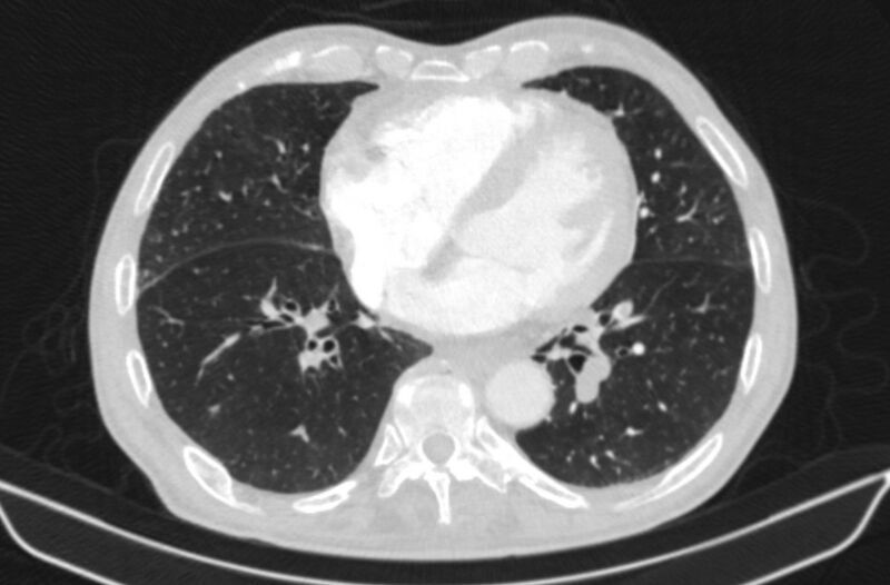File:Chronic pulmonary embolism (Radiopaedia 91241-108843 Axial lung window 61).jpg