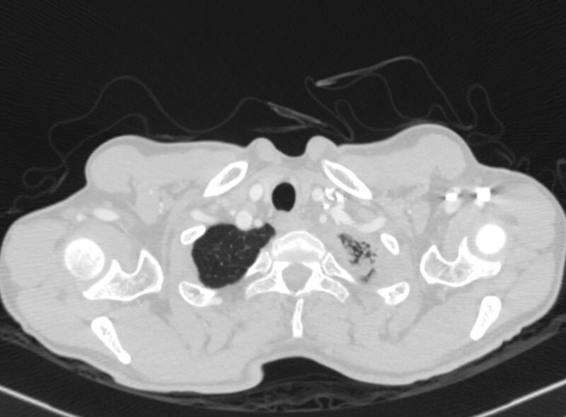 File:Chronic pulmonary embolism with bubbly consolidation (Radiopaedia 91248-108850 Axial lung window 3).jpg