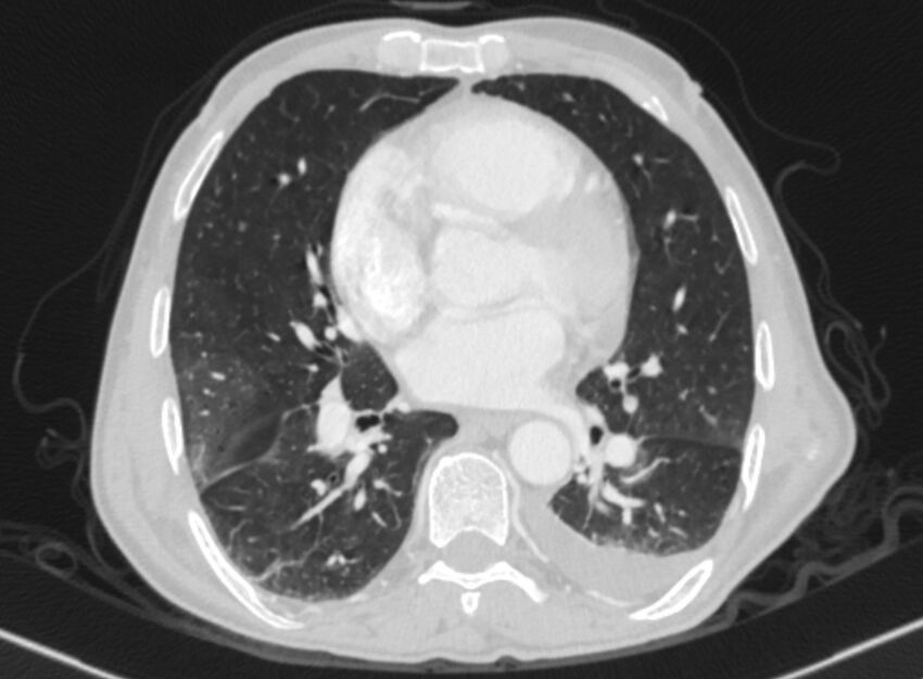 Chronic pulmonary embolism with bubbly consolidation (Radiopaedia 91248-108850 Axial lung window 94).jpg