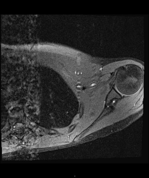 File:Chronic reactive multifocal osteomyelitis (CRMO) - clavicle (Radiopaedia 56406-63071 Axial T1 fat sat 16).jpg