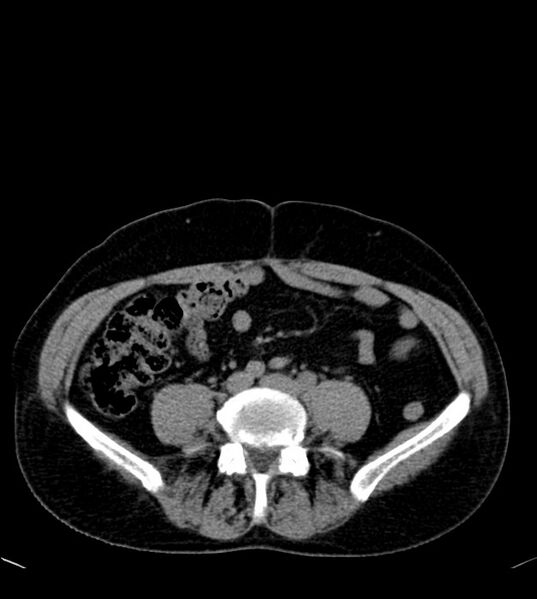 File:Clear cell renal cell carcinoma (Radiopaedia 85006-100539 Axial non-contrast 58).jpg