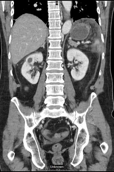 File:Closed loop bowel obstruction and ischemia (Radiopaedia 86959-103180 B 29).jpg